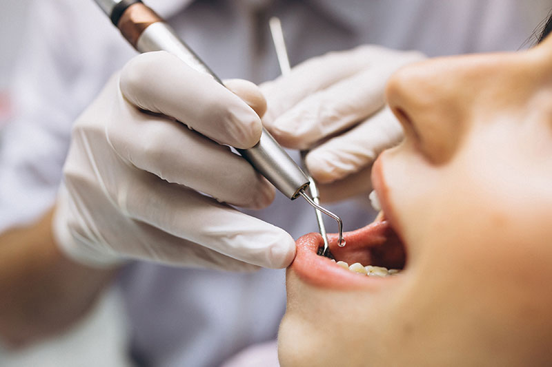 Saber qué es una endodoncia nos ayudará a tomar acciones para evitar este procedimiento. 