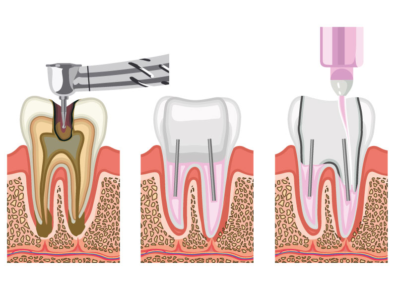 Saber qué es una endodoncia y cuál es el procedimiento para repararla reducirá tu estrés ante esta intervención. 