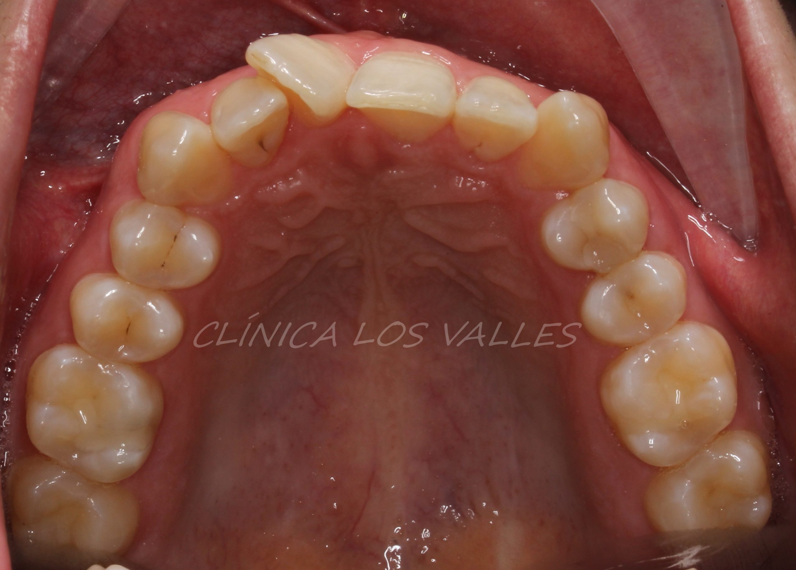 Imagen antes del tratamiento con alineadores transparentes. Con la ayuda de microtornillos temporales, nuestro paciente consiguió una distalización total o un movimiento de los dientes que le llevó finalmente a un engranaje perfecto en clase 1.