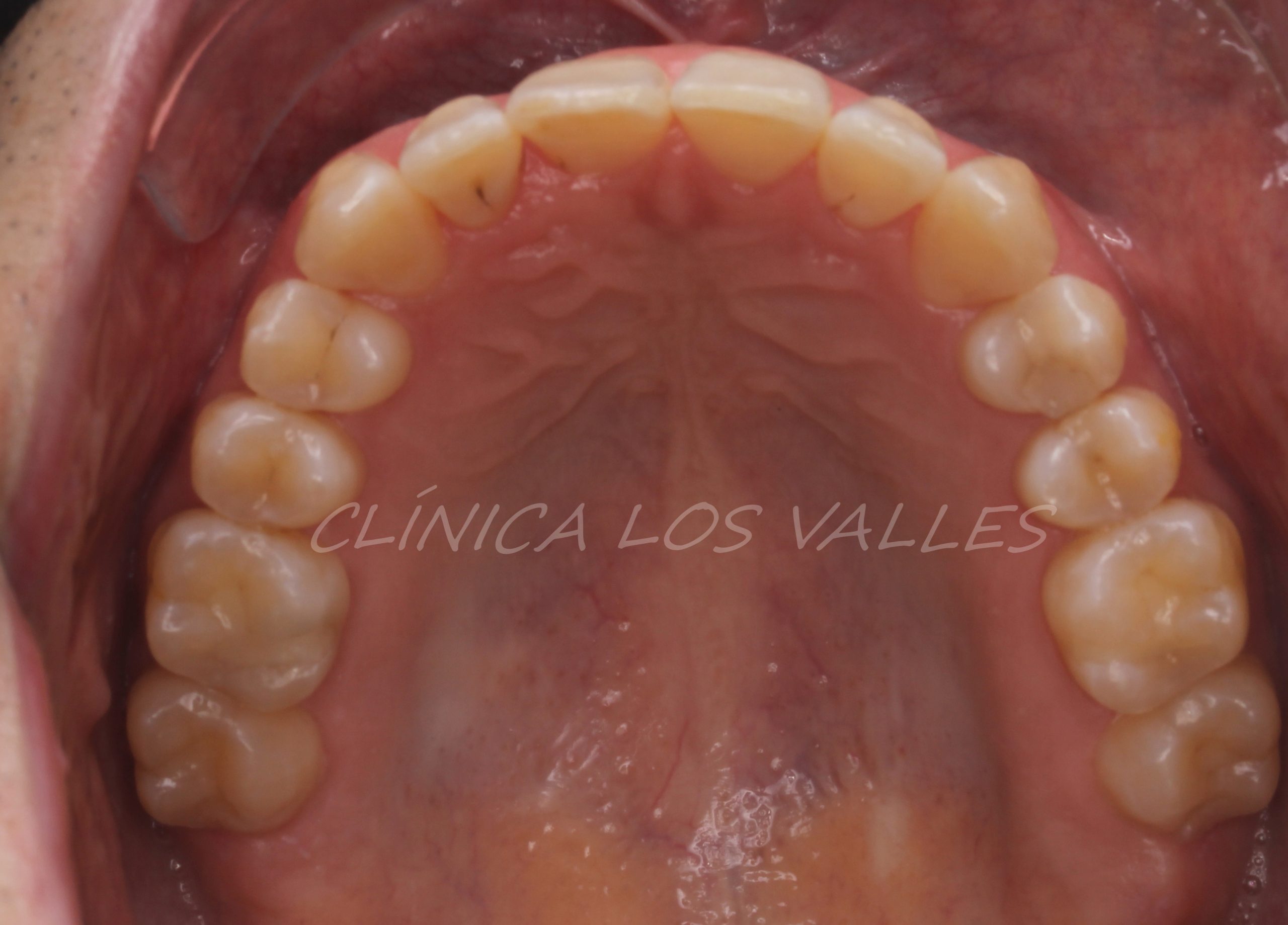 Imagen después del tratamiento con alineadores transparentes. Nuestro objetivo global fue conseguir una amplitud en la sonrisa y engranar la masticación para que no fuera patológica. Además, de rotar el incisivo central para que encajara todo a la perfección.