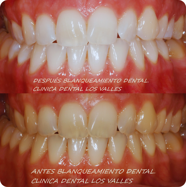 Antes y después de un caso clínico tratado con blanqueamiento dental en nuestra clínica dental Los Valles en Guadalajara. Con este paciente conseguimos un color natural al consiguiendo evitar el café y las manchas dentales. 