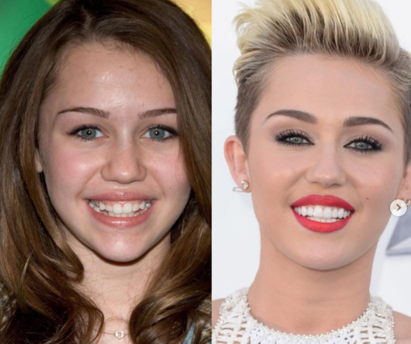 Los famosos no nacen con la sonrisa perfecta. Muchos utilizan tratamientos que son accesibles para muchas personas. 