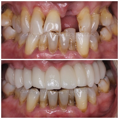 En nuestra Clínica dental Los Valles en Guadalajara siempre apostamos por la calidad, seguridad y control de nuestros materiales quirúrgicos en consulta. Por lo tanto, siempre ofrecemos una implantología avanzada para ofrecer un servicio con las mejores garantías reguladas a nuestros pacientes. Por esta razón, las alertas sanitarias dentales no van con nuestros tratamientos.