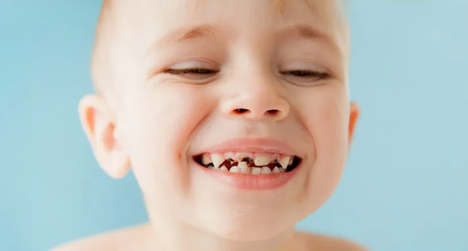 Según el Libro Blanco, el tratamiento de la caries en dientes de leche en nuestro país, “sólo está tratado en 3 de cada 10 lesiones de caries en dientes de leche y sólo el 35% de los niños de hasta 6 años no ha visitado aún al Odontopediatra. Además, se explica que 1 de cada 5 menores tiene episodios frecuentes de dolor dental debido al estado de su boca”. 
