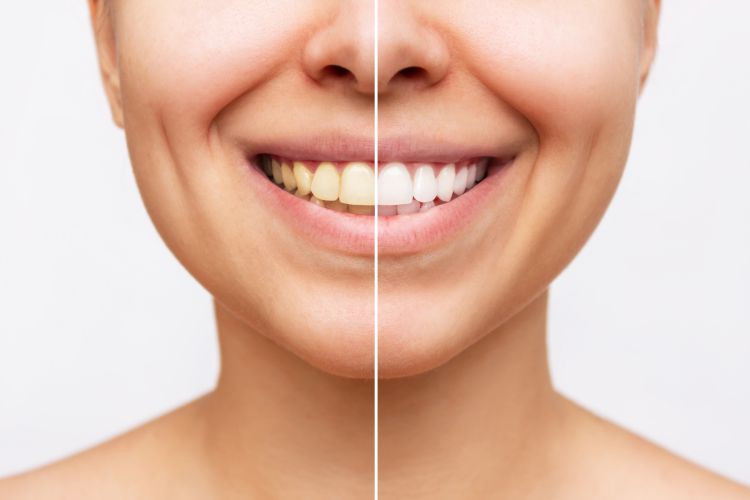 Entre sus beneficios: las manchas dentales se eliminan gracias a la limpieza dental y sus beneficios. 