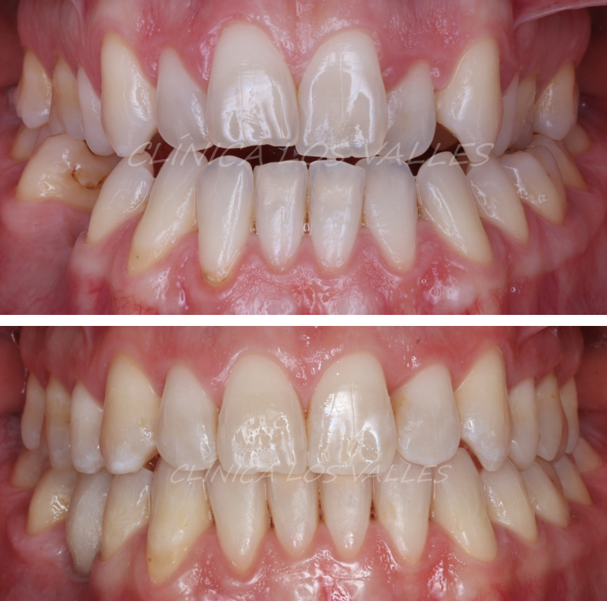Nuestro paciente fue atendido con ortodoncia invisible para cerrar la mordida abierta y la mordida posterior. Tras una recidiva de una ortodoncia anterior, este caso complejo se muestra con un tratamiento sin extracciones y en un tiempo reducido
