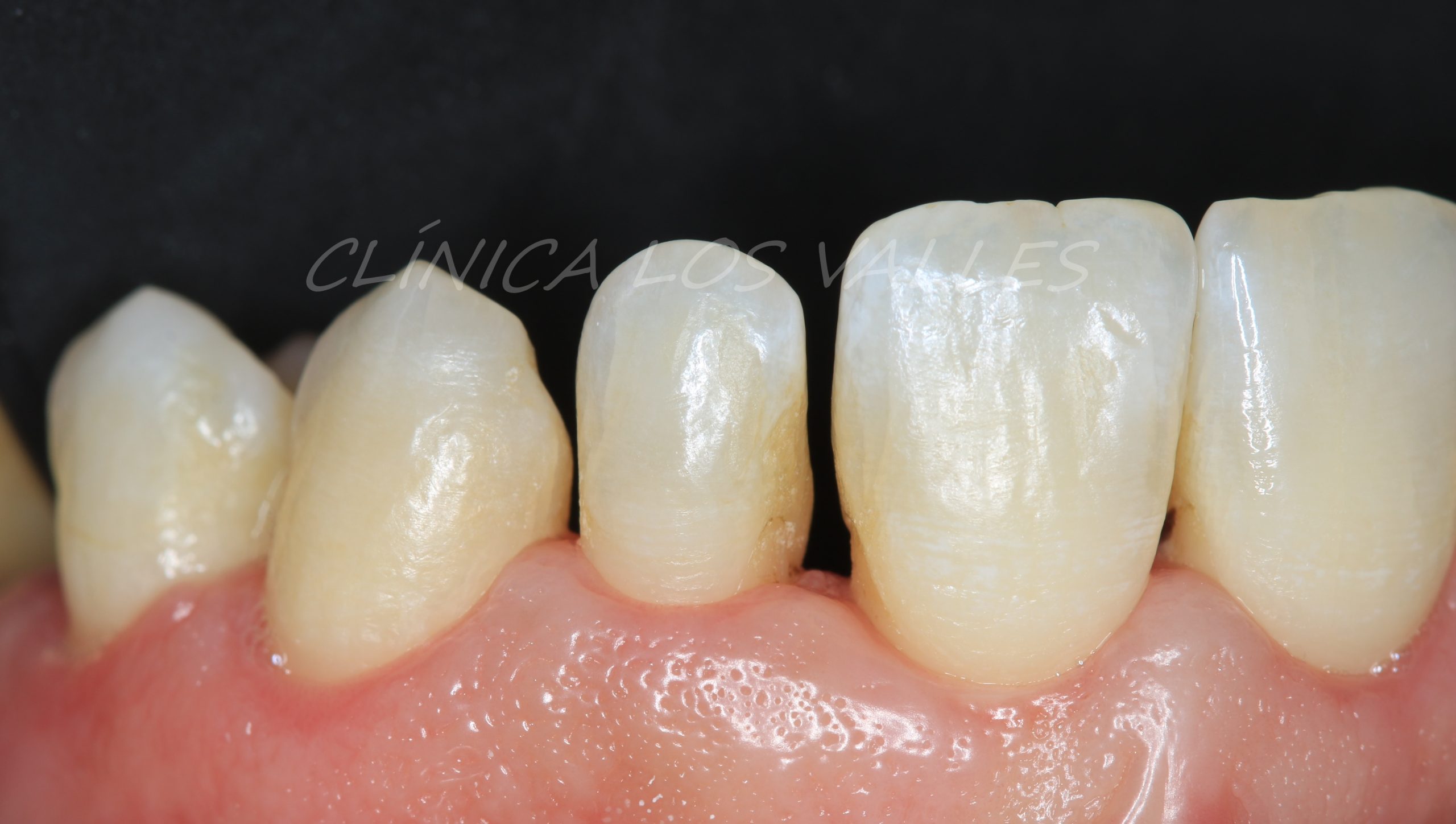 Imagen de caso clínico con carillas ultrafinas. Las carillas ultrafinas son láminas extremadamente finas, fabricadas en cerámica o porcelana de alta calidad, y personalizadas para conseguir una sonrisa natural. Gracias a sus materiales para el diseño de tu sonrisa, se adaptan a la parte visible del diente para mejorar su forma, color, tamaño y armonía estética. 