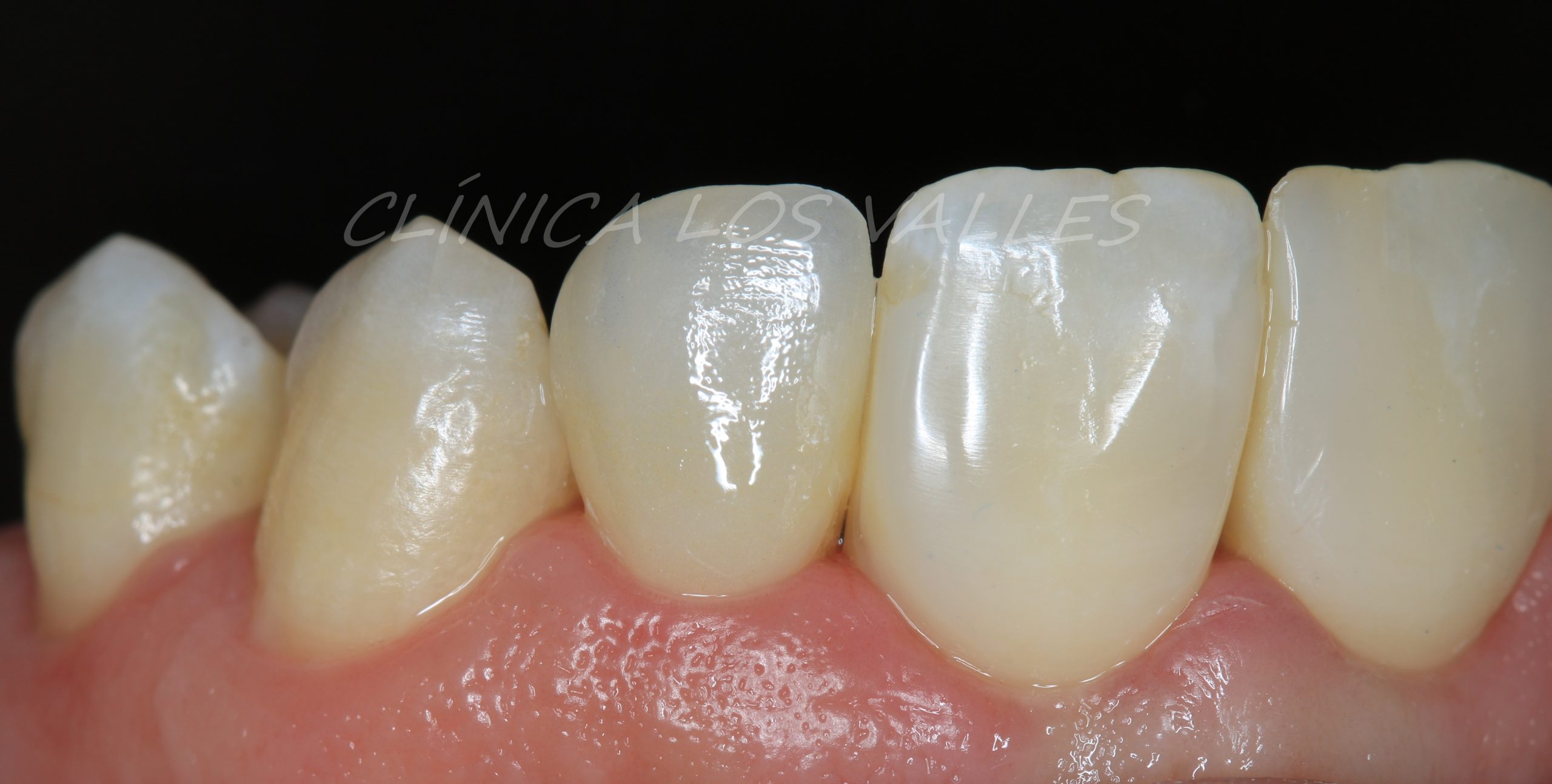 Caso después del tratamiento de carillas ultrafinas. Además de embellecer la sonrisa, las carillas ultrafinas pueden corregir problemas como manchas profundas, desgastes dentales, pequeñas fracturas o diastemas sin necesidad de recurrir a ortodoncia y siempre cuando el caso sea clínicamente apto.