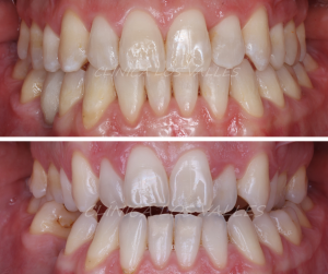 caso clínico con ortodoncia invisible para tratar la mordida en Guadalajara