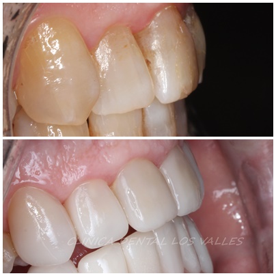 Imagen antes y después del tratamiento de carillas ultrafinas por nuestros expertos de Clínica dental Los Valles en Guadalajara, España. 