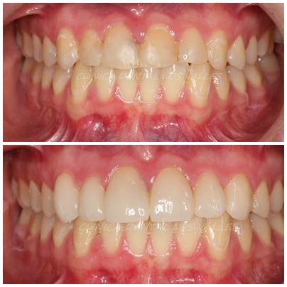 caso clínico antes y después de un tratamiento de carillas. Hay que tener en cuenta que los dientes no están diseñados para ser lijados ni modificados sin una planificación clínica. Porque cada vez que alguien decide limarse los dientes con lima de uñas, está alterando de forma irreversible su estructura, alterando la capa natural más importantes de tu boca: el esmalte dental.