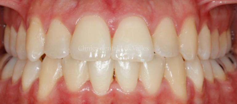 El blanqueamiento dental para bodas y eventos en Guadalajara elimina manchas provocadas por el café, el tabaco o el paso del tiempo, devolviendo frescura a la sonrisa.  Porque nuestros tratamientos en estética dental marcan la diferencia frente a soluciones caseras, al ofrecer supervisión odontológica.