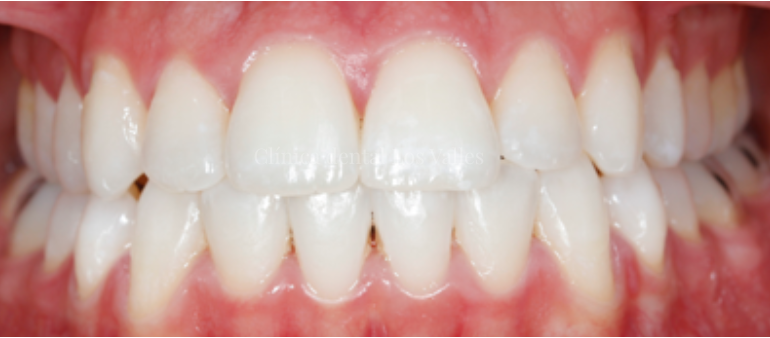 El blanqueamiento dental es uno de los tratamientos más demandados dentro de nuestra estética dental en Guadalajara. Se trata de un procedimiento seguro, eficaz y supervisado por profesionales que permite aclarar varios tonos el color de los dientes con Luz Led. El resultado es una sonrisa más luminosa, rejuvenecida y saludable, ideal para destacar en cualquier evento importante. 