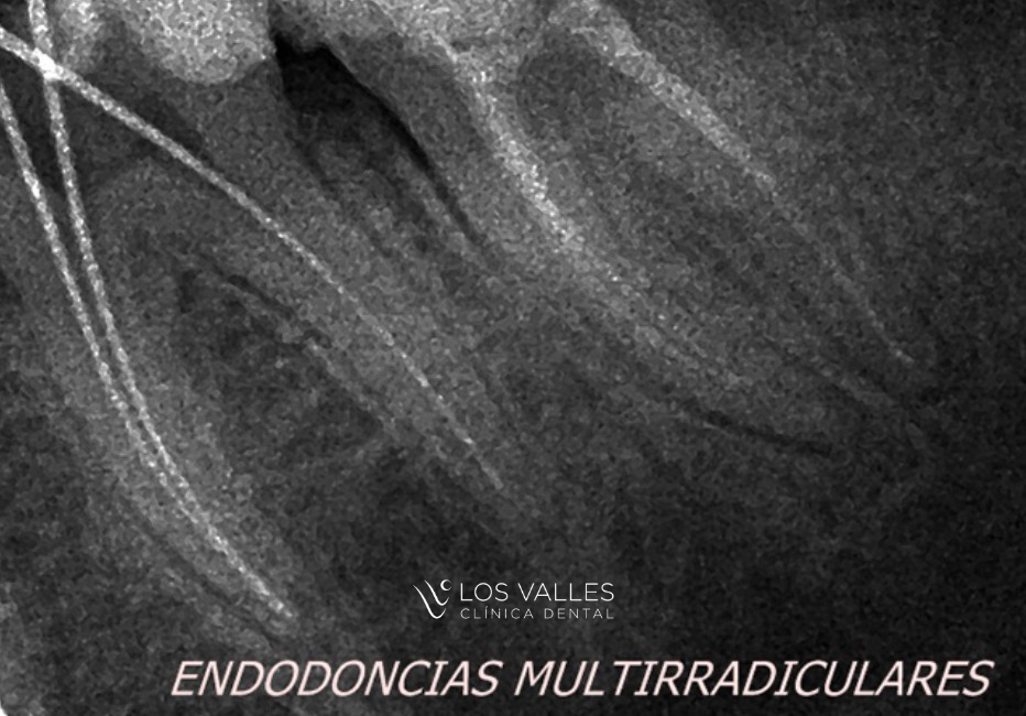 cómo salvar un diente con una endodoncia Cuando un diente es tratado con una infección profunda o un daño importante, muchas personas creen que la única solución es extraerlo. Sin embargo, gracias a los avances de la odontología moderna, hoy en día es posible salvar un diente en muchos casos mediante un tratamiento de endodoncia. En Clínica dental Los Valles, nuestros expertos siempre apuestan por una odontología conservadora, una filosofía que busca mantener las piezas dentales naturales siempre que sea posible.