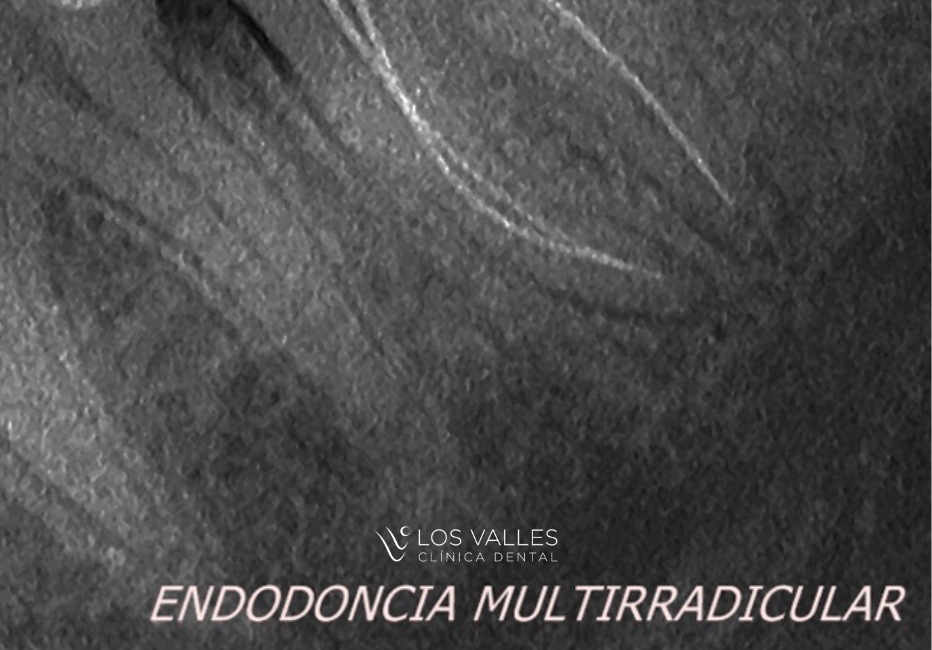 cómo salvar un diente con una endodoncia Muchas personas retrasan su visita al dentista porque el dolor desaparece temporalmente o porque creen que la molestia no es importante. Sin embargo, cuando una infección dental avanza, puede comprometer seriamente la estructura del diente y reducir las posibilidades de conservarlo.