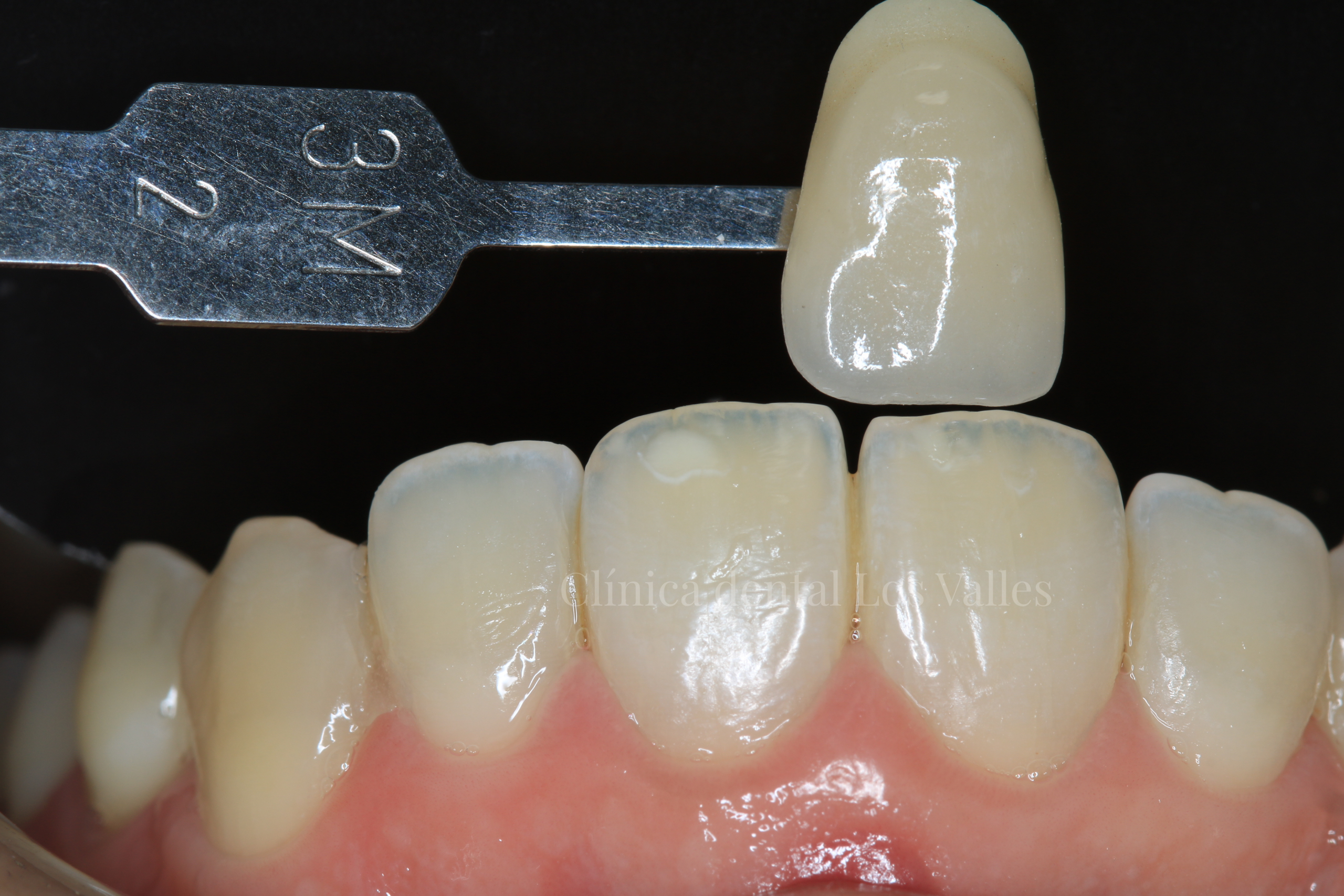 estética dental y sonrisas Carillas dentales, antes y después, en estética dental y sonrisas de nuestra Clínica dental Los Valles en Guadalajara.
