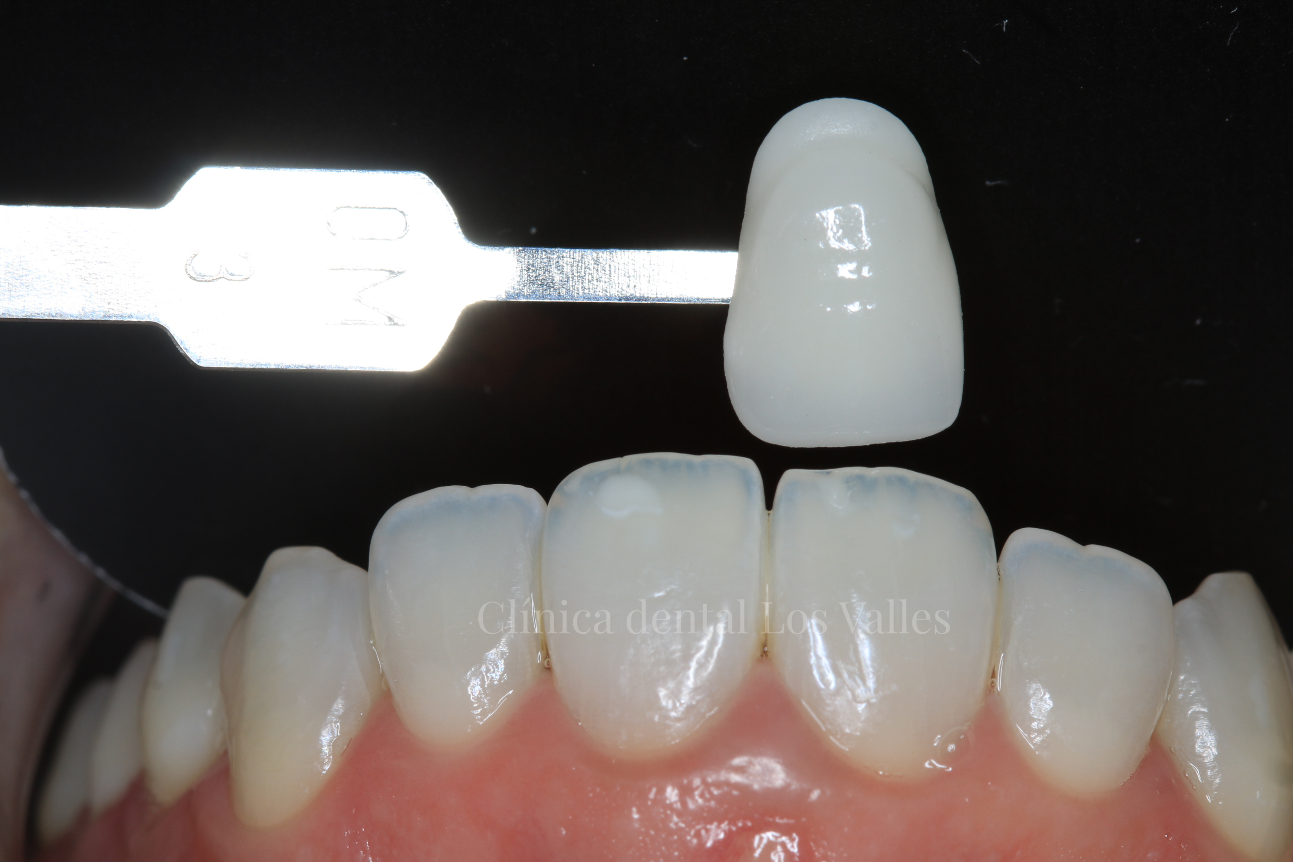 estética dental y sonrisas Carillas dentales, antes y después, en estética dental y sonrisas de nuestra Clínica dental Los Valles en Guadalajara.