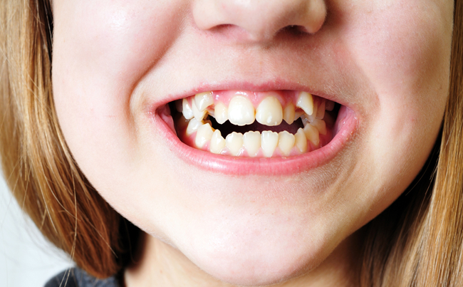 La agenesia dental te ayuda a eliminar dientes de leche supletorios.