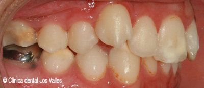 Imagen antes del tratamiento con ortodoncia Damon Ⓒ Clínica dental Los Valles