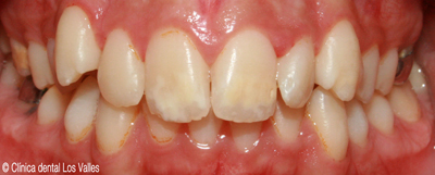 Imagen antes del tratamiento con ortodoncia Damon Ⓒ Clínica dental Los Valles