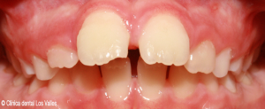 antes-tratamiento-ortodoncia-dental-guadalajara