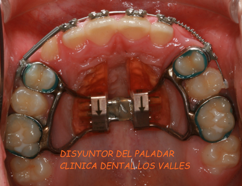 Nuevos Dientes Ortodoncia Aparato Aparato Aparato Aparatos