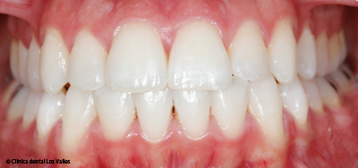 blanqueamiento-dental-guadalajara blanqueamiento-dental-guadalajara