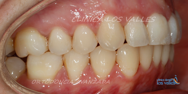 En Clínica dental Los Valles se propuso realizar una tratamiento con ortodoncia invisible Invisalign mediante alineadores trasparentes para tratar el bruxismo.