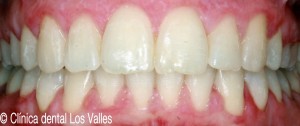 Imagen después del tratamiento con ortodoncia Ⓒ Clínica dental Los Valles