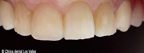 Caso clínico después del tratamiento con carillas de porcelana en Clínica dental Los Valles.