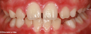 despues-ortodoncia-clinica-dental-guadalajara