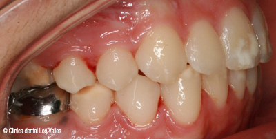 Imagen después del tratamiento con ortodoncia Damon Ⓒ Clínica dental Los Valles