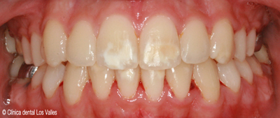 Imagen después del tratamiento con ortodoncia Damon Ⓒ Clínica dental Los Valles