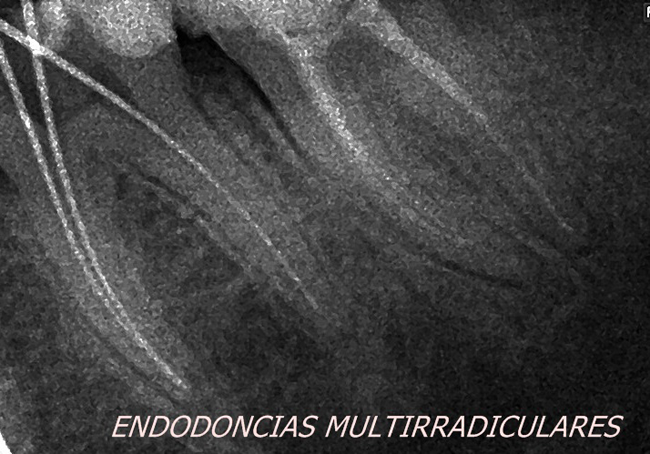 endoncia%multirradicular endodoncia1multirradicular3