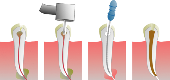 endodoncia/multirradicular endodoncia2