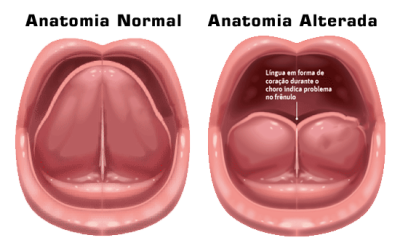 frenectomia, frenillo lingual