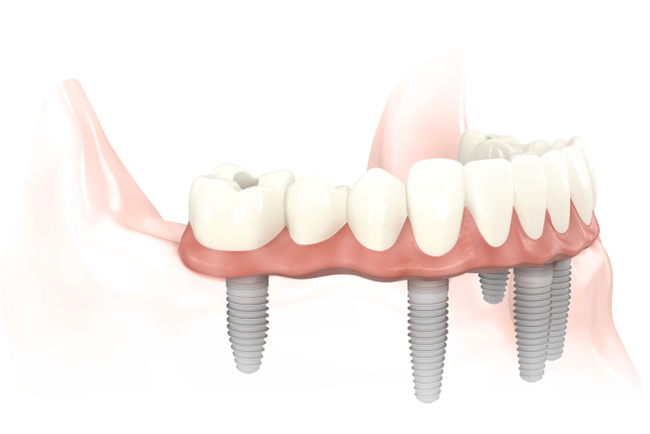 Las fundas de zirconio no van a tener caries pero el diente que les sirve como pilar sí si no lo cuidas, y las encías que sostienen ese diente tampoco están libres de padecer gingivitis o periodontitis.