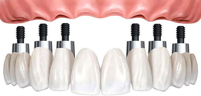 los implantes dentales nos permiten desde la reposición de un solo diente o un molar perdido a rehabilitaciones complejas 