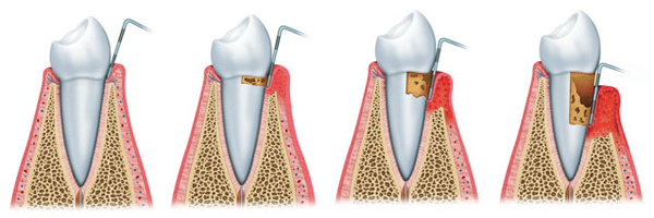 implantes-dentales3