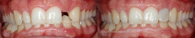 La cirugía guidada es uno de los mejores tratamientos en el postoperatorio de los implantes dentales