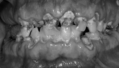 implantes-dentales-casos-clinicos implantesdentales