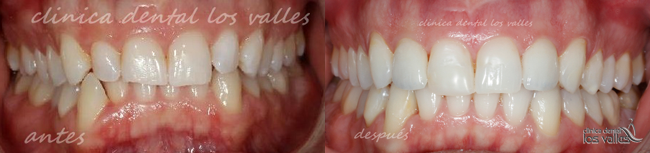 Caso clínico de Invisalign Platinum Provider de Clínica dental Los Valles de Guadalajara. Imagen antes y después de ser tratado por ortodoncia invisalign por la Dra. María Hernández.