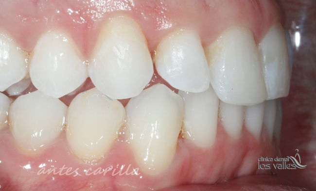 ortodoncia-invisalign