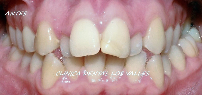 Caso antes de ser tratado por ortodoncia invisible Invisalign por la Dra. María Hernández en nuestra Clínica dental Los Valles de Guadalajara.
