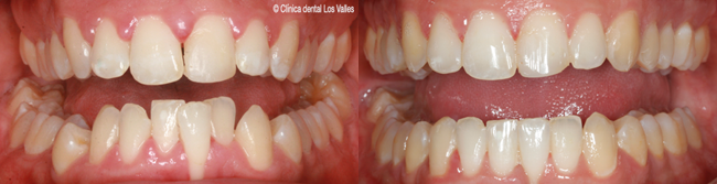 ortodoncia-invisible-invisalign-mordida-cruzada mordida-cruzada7