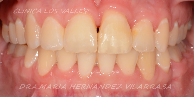 Este caso clínico fue tratado con ortodoncia extrema durante dos años por nuestros expertos dentales en Guadalajara 