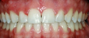 Imagen después de la ortodoncia con brackets Damon.  © Clínica dental Los Valles