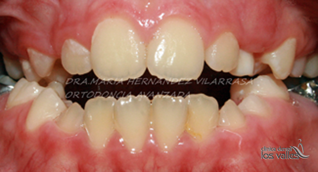 ortodoncia-infantil-2