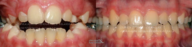 Caso clínico de Clínica dental los Valles con ortodoncia infantil, tras quitar, en este caso, los brackets metálicos, Incognito e Invisalign.