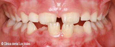 ortodoncia-infantil-guadalajara
